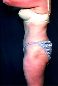 Abdominoplasty | Mansfield | Cedar Hill