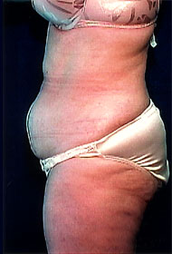 Abdominoplasty | Mansfield | Cedar Hill