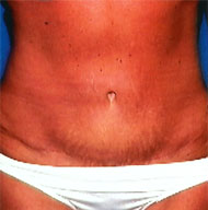 Abdominoplasty | Mansfield | Cedar Hill