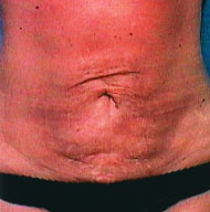 Abdominoplasty | Mansfield | Cedar Hill