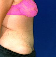 Abdominoplasty | Mansfield | Cedar Hill