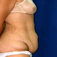 Abdominoplasty | Mansfield | Cedar Hill