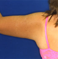 Brachioplasty | Arm Lift | Mansfield | Cedar Hill