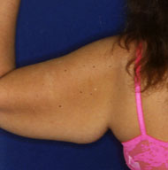 Brachioplasty | Arm Lift | Mansfield | Cedar Hill