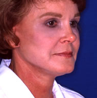 Neck Lift | Mansfield | Cedar Hill