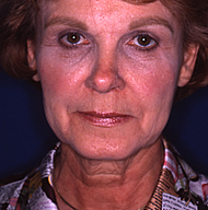 Neck Lift | Mansfield | Cedar Hill