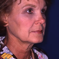 Neck Lift | Mansfield | Cedar Hill