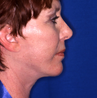 Neck Lift | Mansfield | Cedar Hill