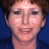 Neck Lift | Mansfield | Cedar Hill
