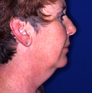 Neck Lift | Mansfield | Cedar Hill