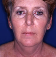 Neck Lift | Mansfield | Cedar Hill